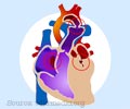 Hypoplastic Left Heart Syndrome