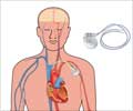Implantable Cardioverter Defibrillator
