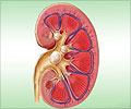 Kidney Stones in Children Kidney Stones in Children