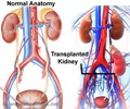 Kidney Transplantation