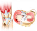 Meniscal Tears