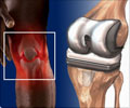 Knee Replacement 