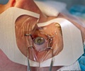 LASIK Eye Surgery
