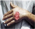 Leishmaniasis Leishmaniasis