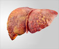 Liver Cancer