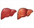 Liver Cirrhosis