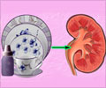 Kidney Failure due to Melamine Toxicity Kidney Failure due to Melamine Toxicity