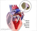 Mitral Valve Stenosis And Mitral Valve Replacement
