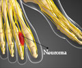 Mortons Neuroma