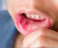 Mouth Ulcers