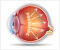 Ocular Hypertension