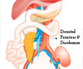 Pancreas Transplantation