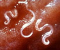 Hookworm Infection