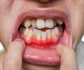 Periodontitis