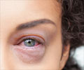 Pink Eye Symptom Evaluation