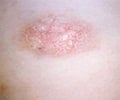 Pityriasis Rosea - Support Groups