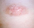 Pityriasis Rosea Pityriasis Rosea