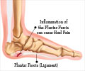 Plantar Fasciitis