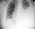 Pleural Effusion
