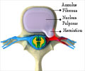 Prolapse of Intervertebral Disc