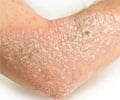 Psoriasis Psoriasis