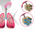 Pulmonary Edema