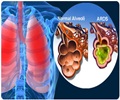Respiratory Distress Syndrome