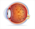 Retinitis Pigmentosa