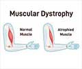 Can Muscle Atrophy be Reversed?