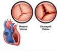Rheumatic Heart Disease (RHD)