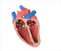 Sick Sinus Syndrome