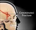 Skull Fractures