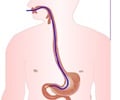 Small Intestine Biopsy Small Intestine Biopsy