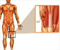 Soft Tissue Sarcoma