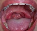 Sore Throat Symptom Evaluation
