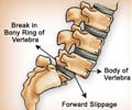 Spondylolisthesis