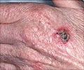 Squamous Cell Cancer of the Skin Squamous Cell Cancer of the Skin