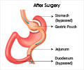 Stomal Stenosis following Gastric Bypass Surgery