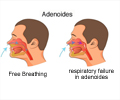 Adenoiditis