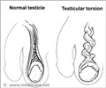Testicle Pain - Symptom Evaluation