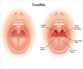 Tonsillitis