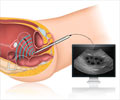 Transvaginal Ultrasound