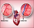 Coronary Artery Bypass Graft (CABG) - Triple Bypass Surgery