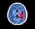 Understanding the Different Types of Brain Hemorrhage