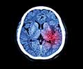 Understanding the Different Types of Brain Hemorrhage