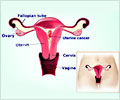 Uterine Cancer