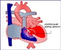 Congenital Heart Disease