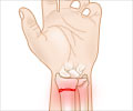 Wrist Sprain