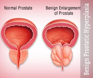 prostatic hyperplasia icd 10)