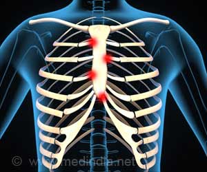 What is Costochondritis & How is it Treated?- Causes, Symptoms, Diagnosis  of Costochondritis